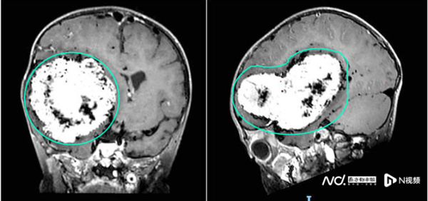 信捷策路 走路不稳、经常呕吐，两岁孩子脑内竟藏10厘米巨瘤